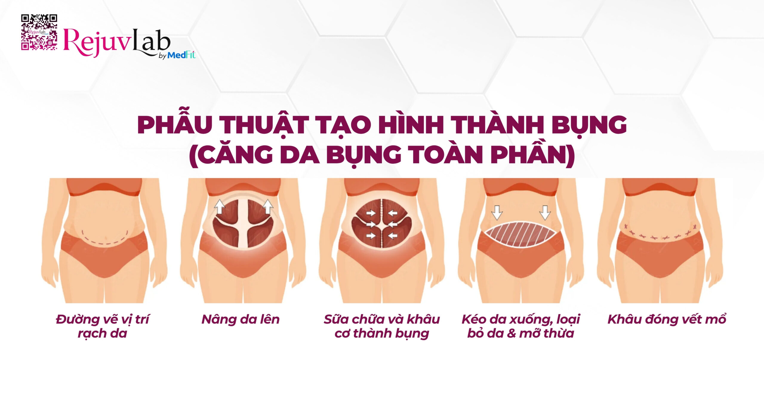 hình minh họa phẫu thuật bụng toàn phần