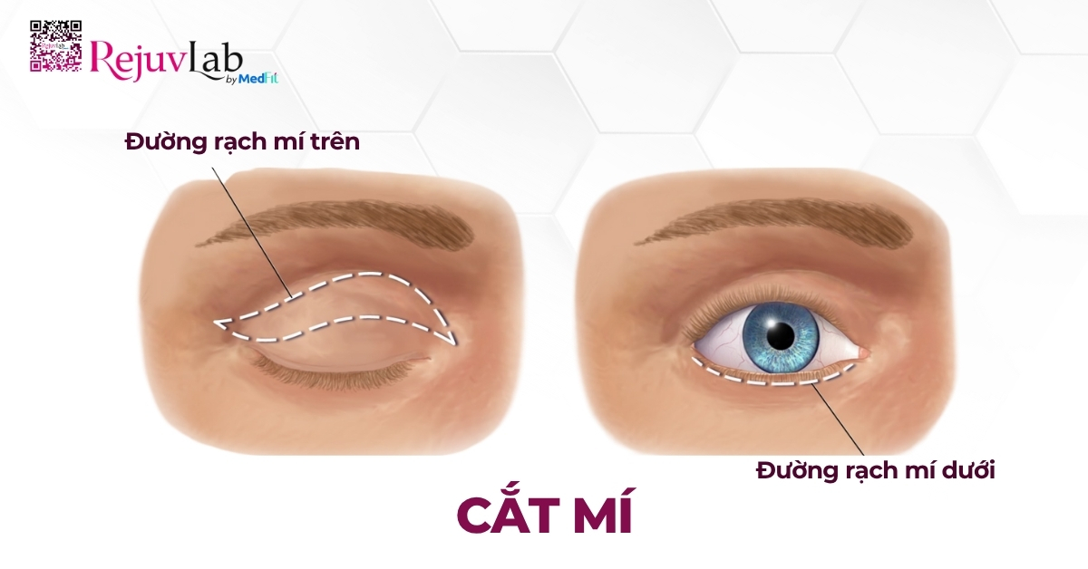 hình minh họa phẫu thuật cắt mí