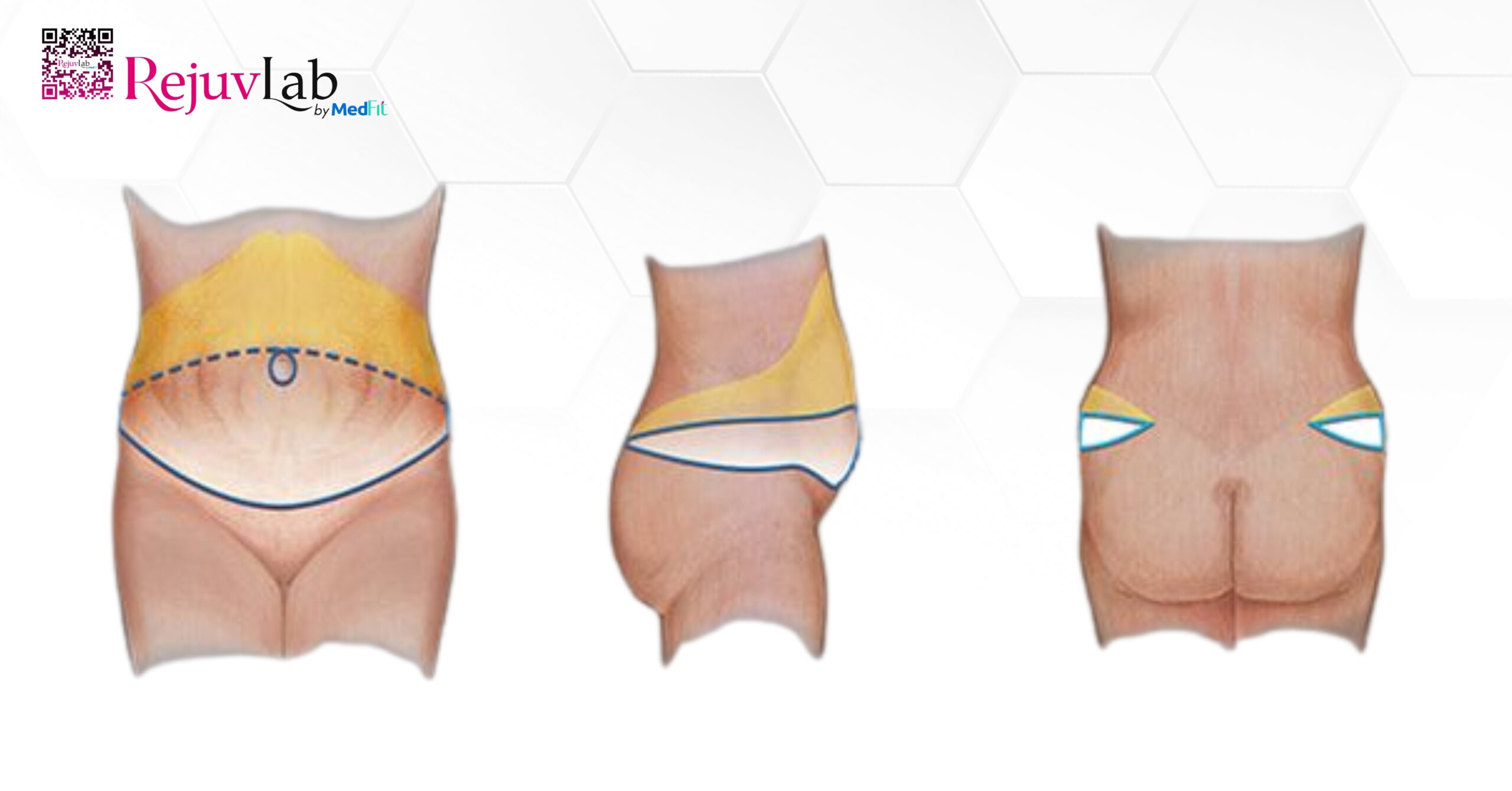 hình minh họa phẫu thuật mở rộng (extended abdominoplasty)