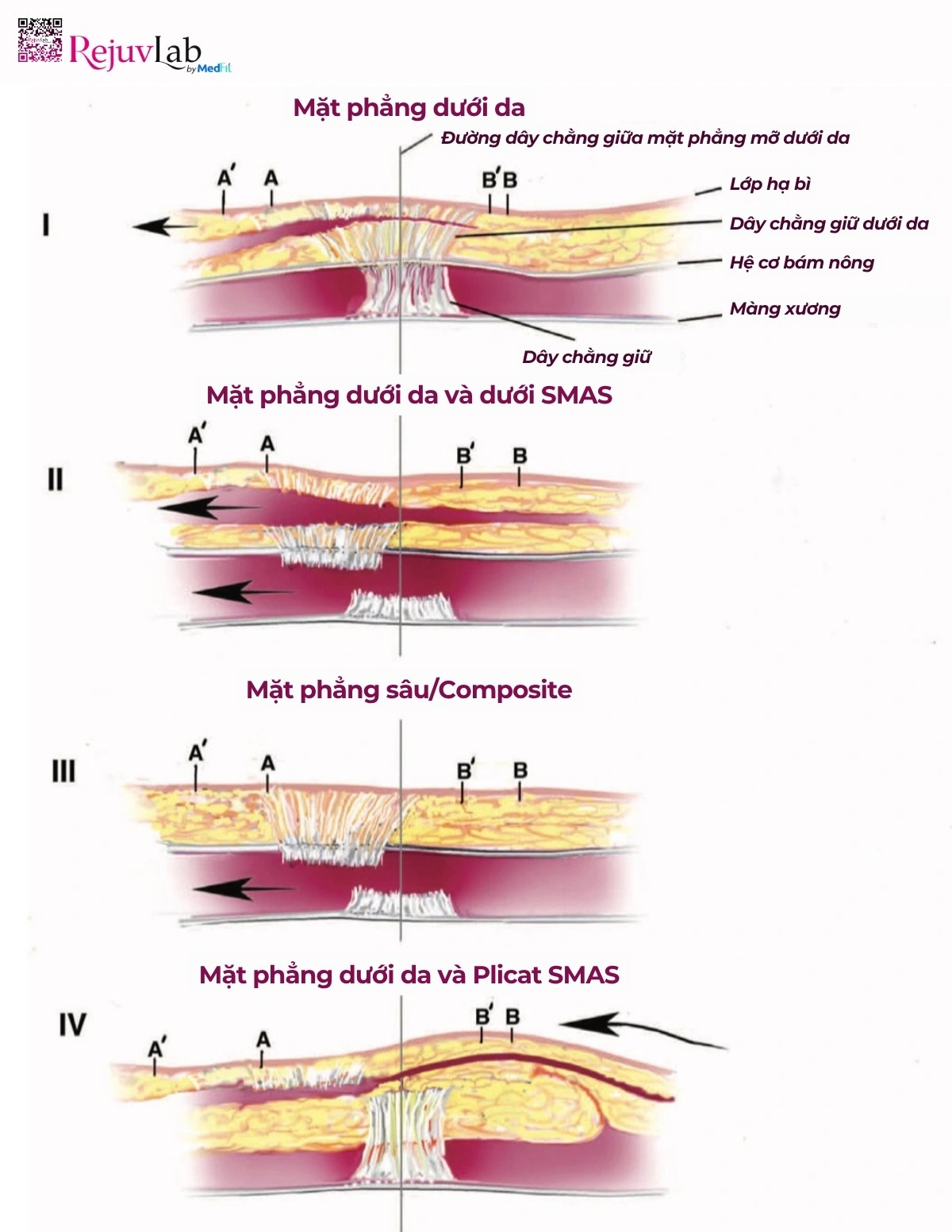 phẫu thuật thẩm mỹ căng da mặt 