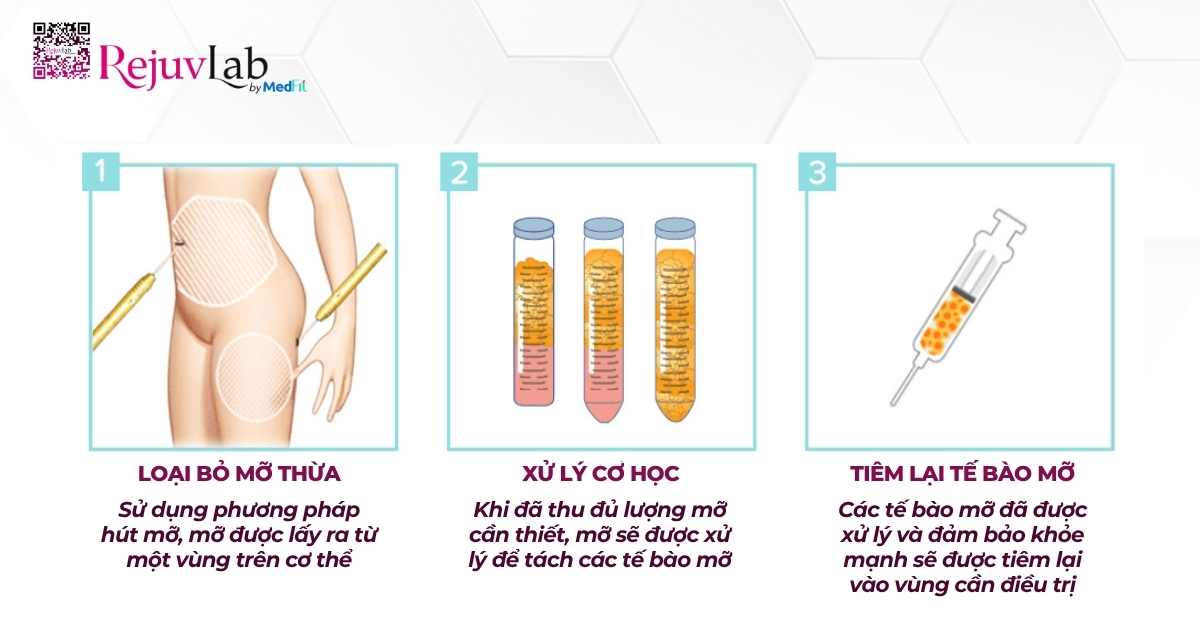 hình minh họa phương pháp cấy mỡ tự thân