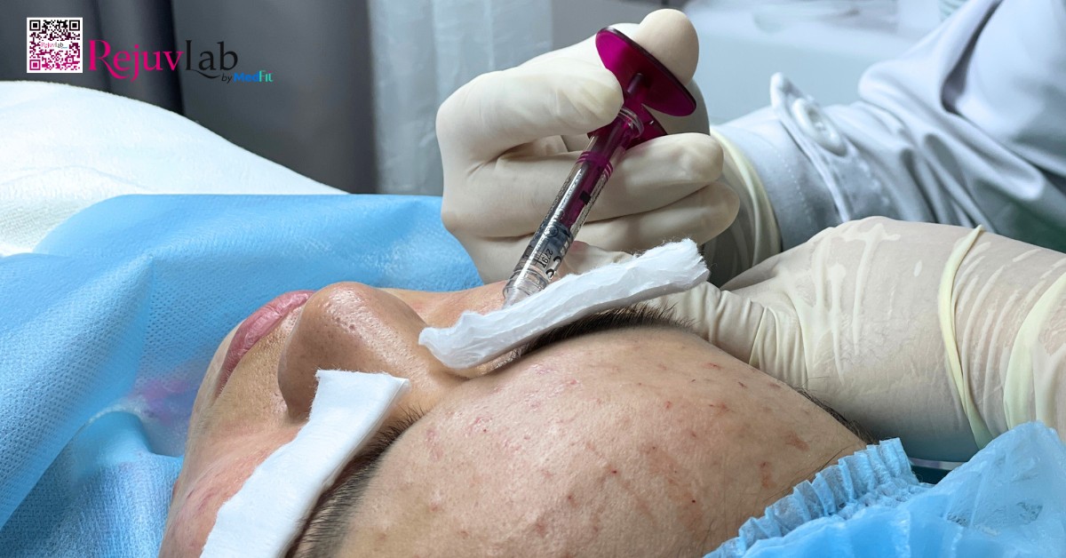 hình minh họa phương pháp tiêm meso