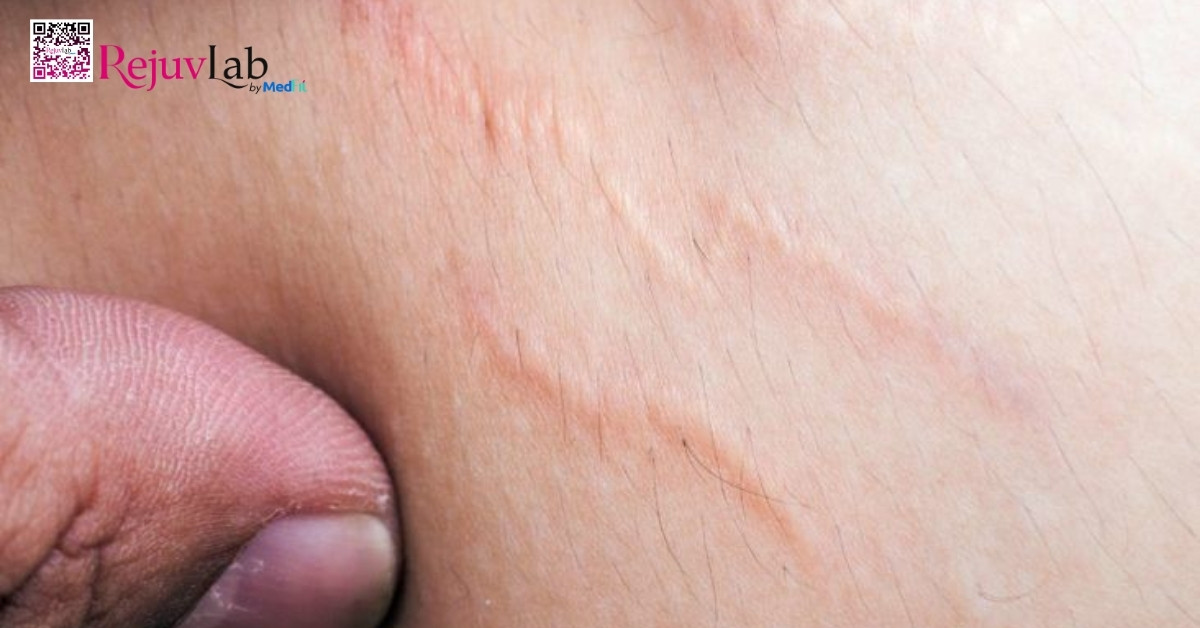 hình minh họa rạn da ở nam giới
