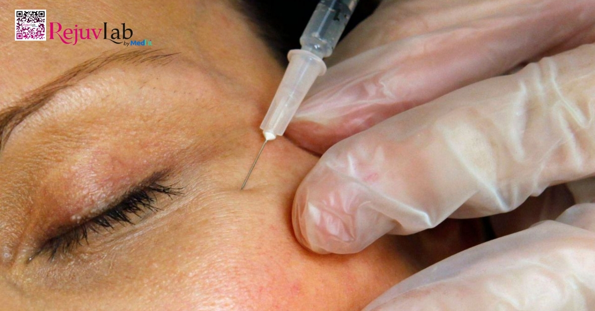 hình minh họa tiêm botulinum toxin trẻ hóa vùng mắt