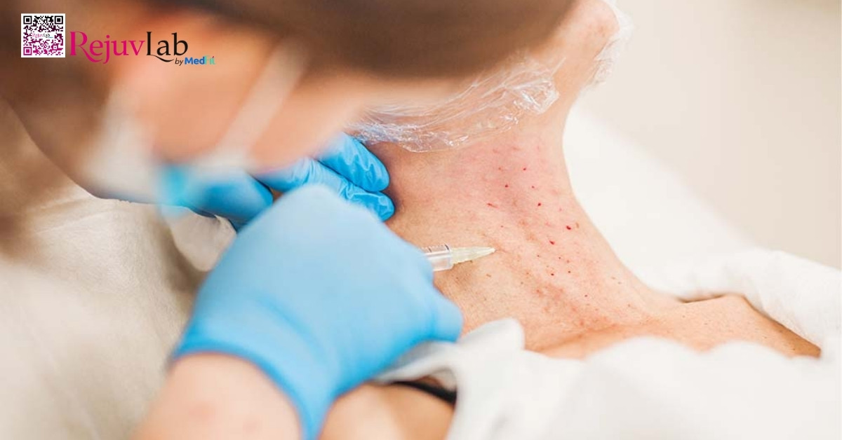 hình minh họa tiêm botulinum toxin vùng cổ