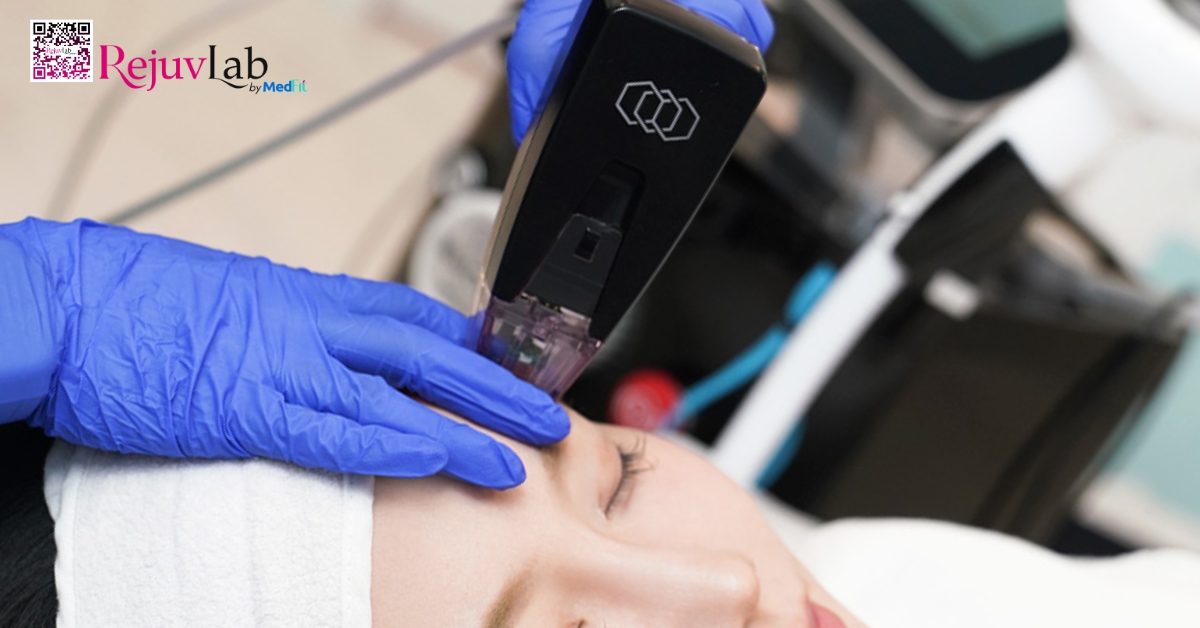 hình minh họa trẻ hóa vùng mắt bằng morpheus8