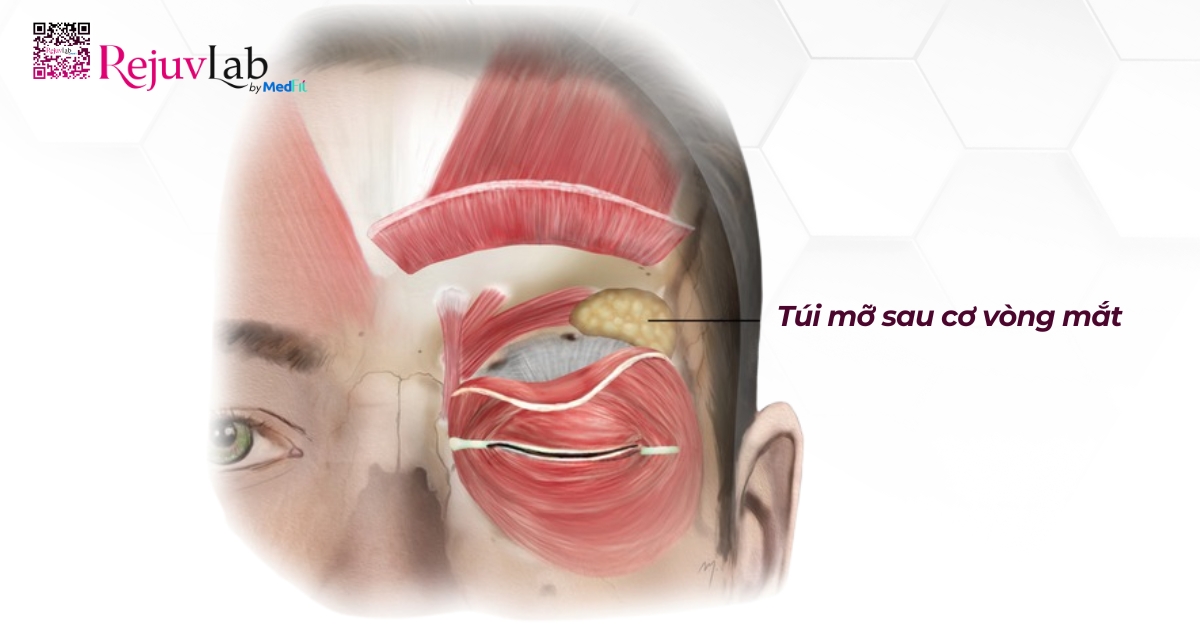 hình minh họa túi mỡ sau cơ vòng mắt