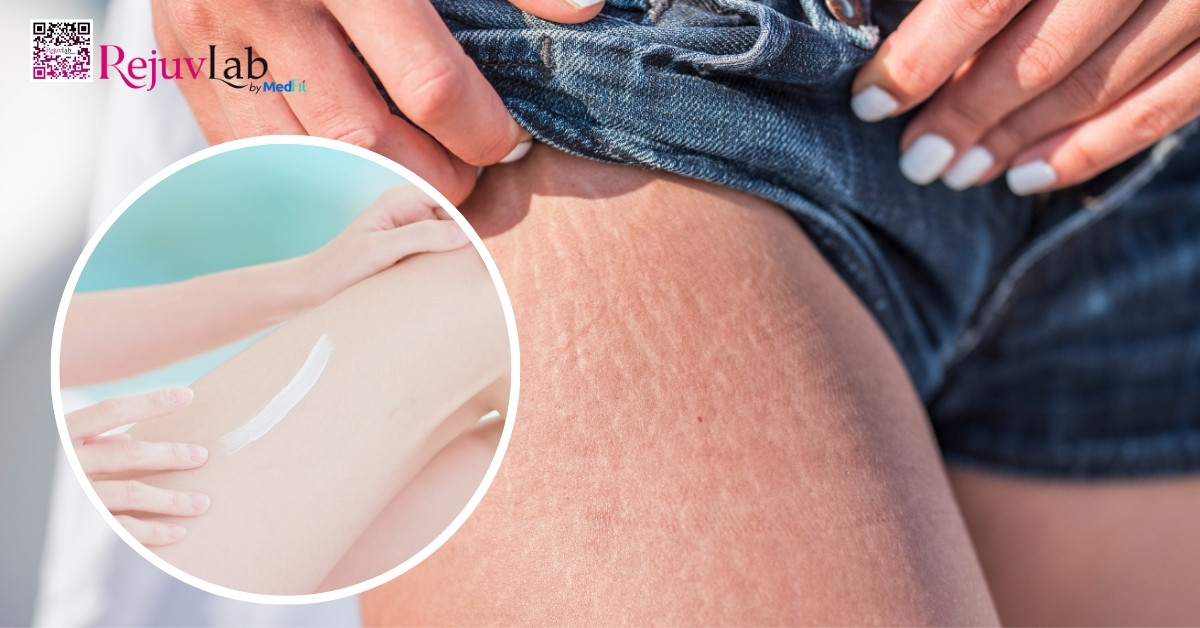 kết hợp bôi thoa các sản phẩm trị rạn da ở đùi và massage