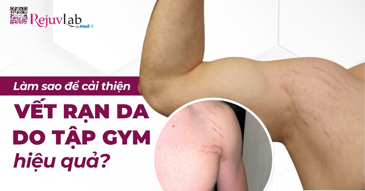 làm sao để cải thiện vết rạn da do tập gym hiệu quả