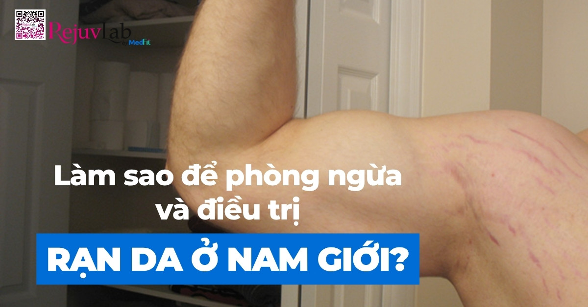 làm sao để phòng ngừa và điều trị rạn da ở nam giới