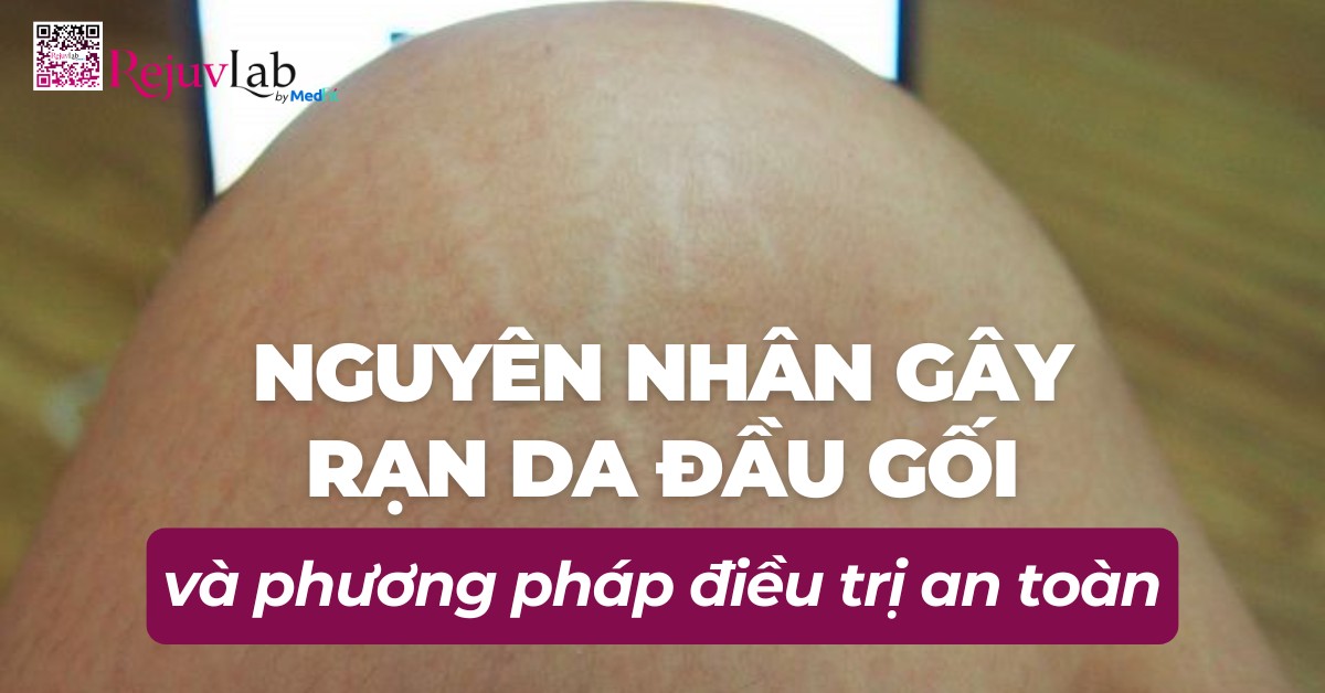 nguyên nhân gây rạn da đầu gối và phương pháp điều trị an toàn
