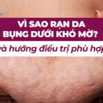 Vì sao rạn da bụng dưới khó mờ và hướng điều trị phù hợp