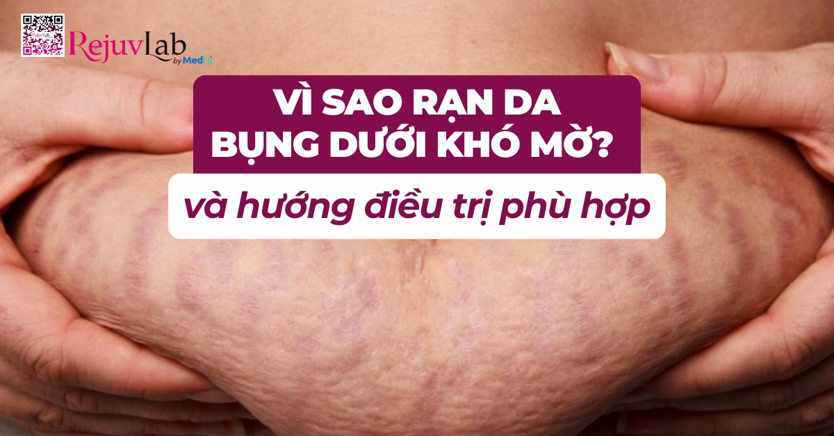 rạn da bụng dưới khó mờ