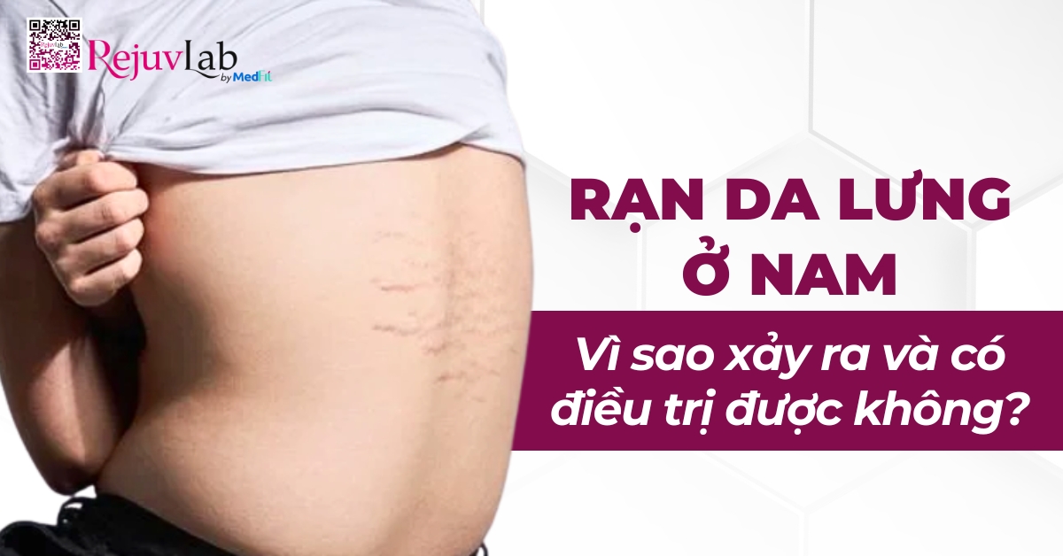 rạn da lưng ở nam vì sao xảy ra