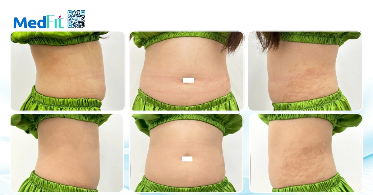 so sánh vòng eo của chị h.y trước và sau liệu trình