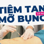 Tiêm tan mỡ bụng giá bao nhiêu?