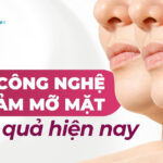 4 công nghệ giảm mỡ mặt hiệu quả hiện nay