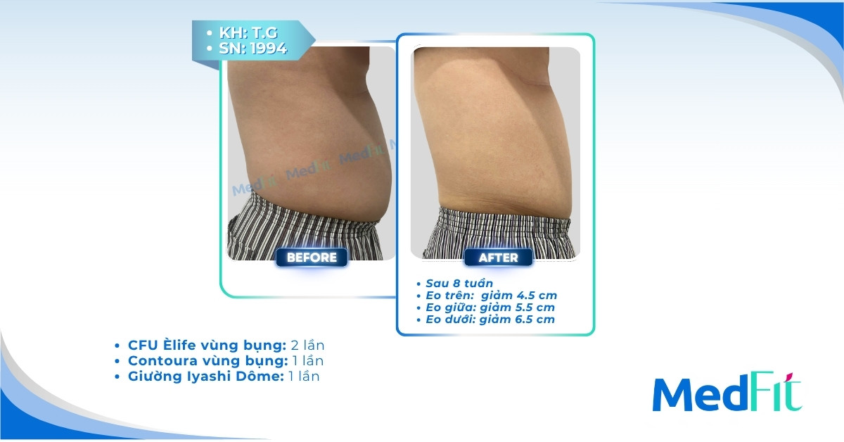 Review hút mỡ toàn thân: Hiệu quả, rủi ro và kinh nghiệm thực tế sau phẫu thuật 35