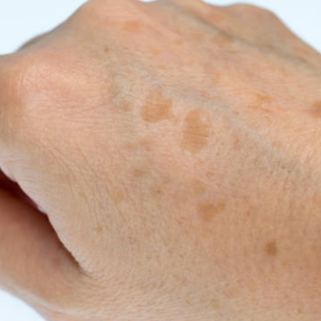 Da có đồi mồi đốm nâu