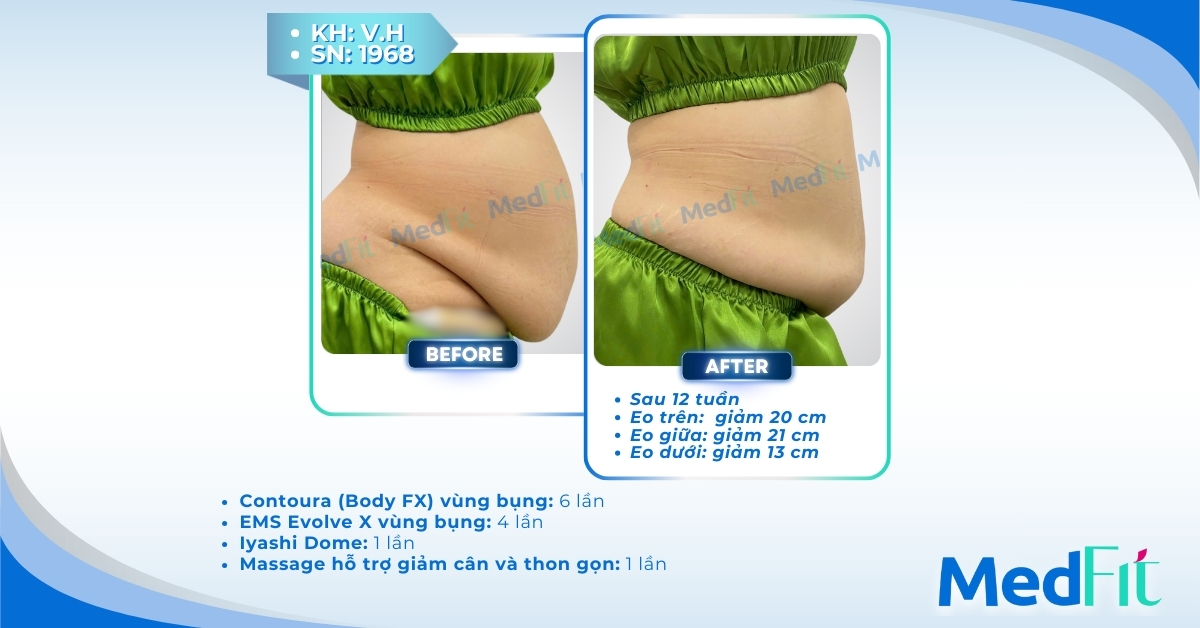ca lâm sàng giảm mỡ bụng tại medfit