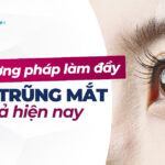 Top 3 phương pháp làm đầy vùng trũng mắt hiệu quả hiện nay