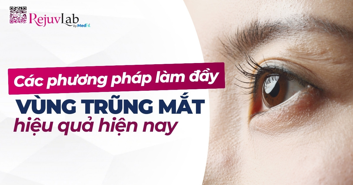 các phương pháp làm đầy vùng trũng mắt hiệu quả hiện nay