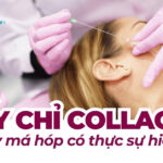 Uống collagen có giúp giảm cân không? 10 Cấy chỉ collagen làm đầy má hóp có thực sự hiệu quả?