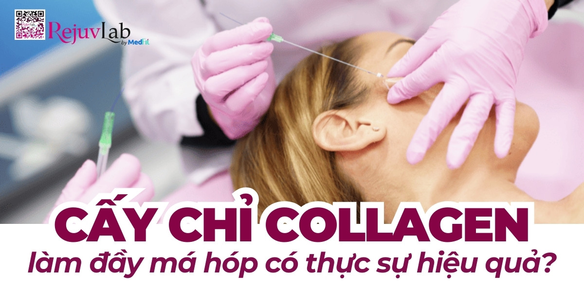 cấy chỉ collagen làm đầy má hóp có thực sự hiệu quả