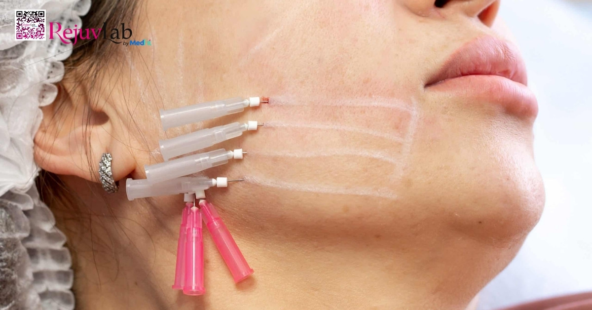 Cấy chỉ collagen làm đầy má hóp có thực sự hiệu quả? 2 cấy chỉ collagen làm đầy má hóp