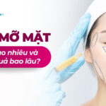Cấy mỡ mặt giá bao nhiêu và hiệu quả bao lâu?