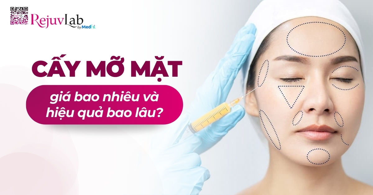 cấy mỡ mặt giá bao nhiêu và hiệu quả bao lâu