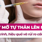 Cấy mỡ tự thân lên mặt: Quy trình, hiệu quả và rủi ro cần biết