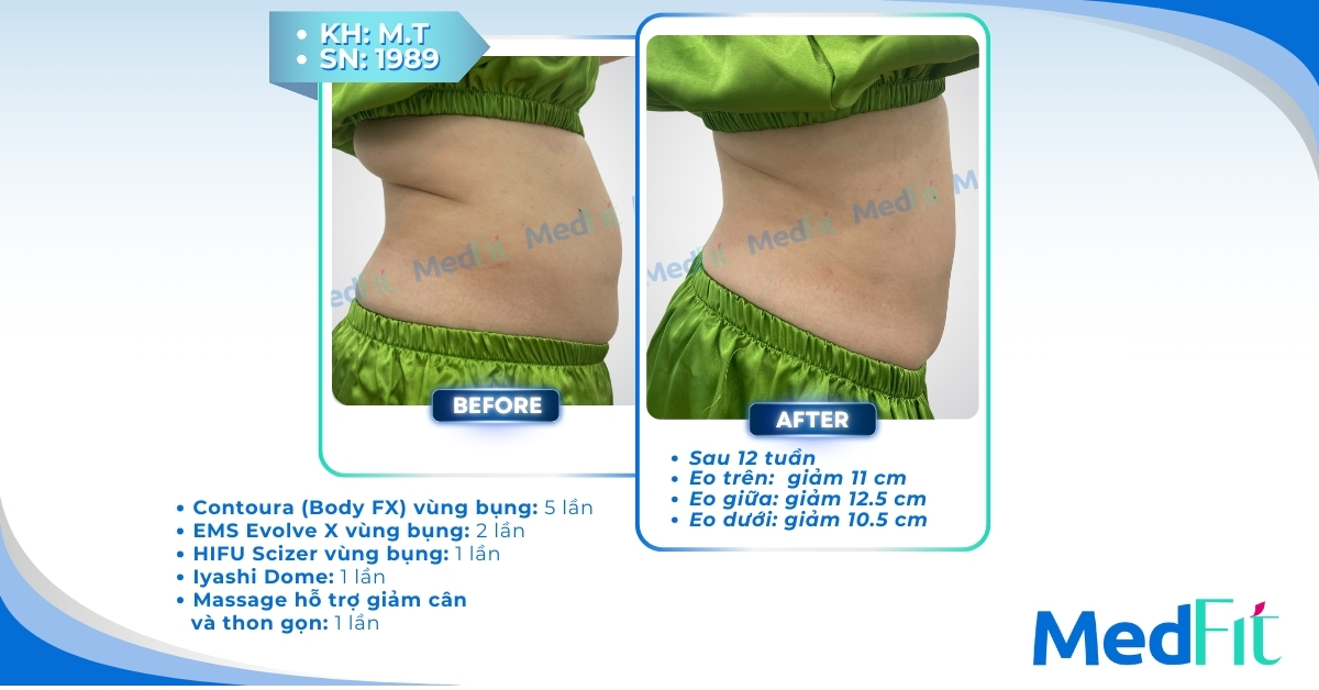 cls giảm mỡ bụng tại medfit