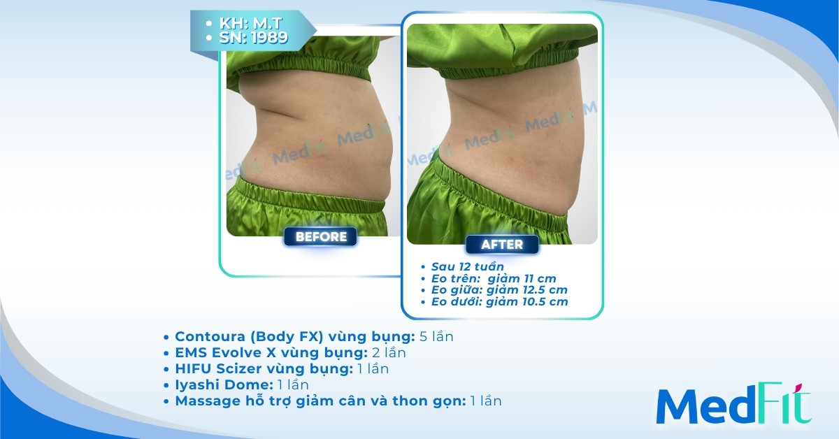 cls giảm mỡ bụng tại medfit