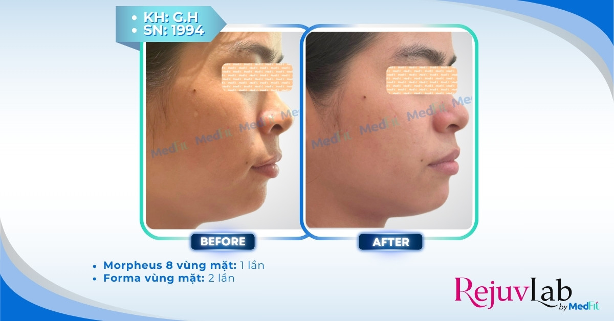 Giảm cân có giúp mặt thon gọn hơn không? 8 cls morpheus8 và forma giảm mỡ và săn chắc da tại rejuvlab