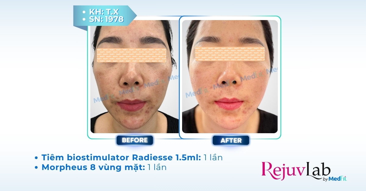 cls tiêm radiesse làm đầy thể tích mặt tại rejuvlab