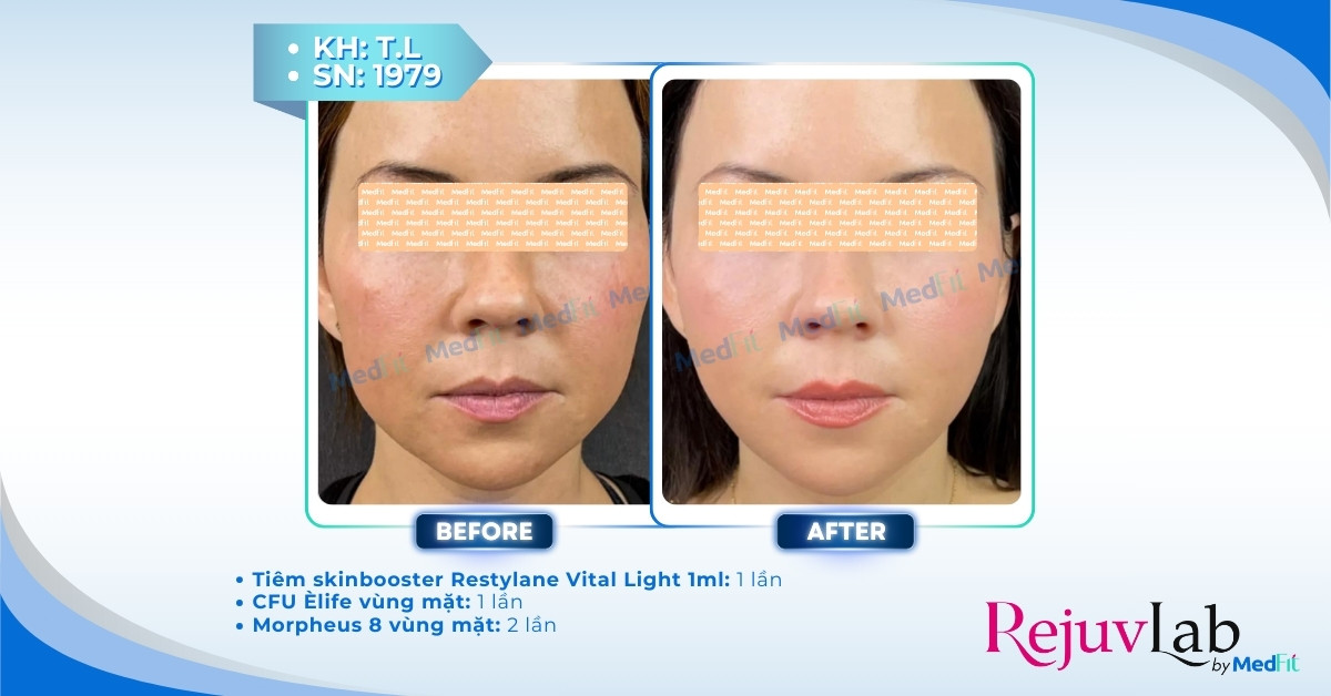 Restylane Vital và Restylane Vital Light: Restylane Skinboosters giúp khôi phục nền da khỏe mạnh từ sâu bên trong 13 cls tiêm restylane vital light tại rejuvlab