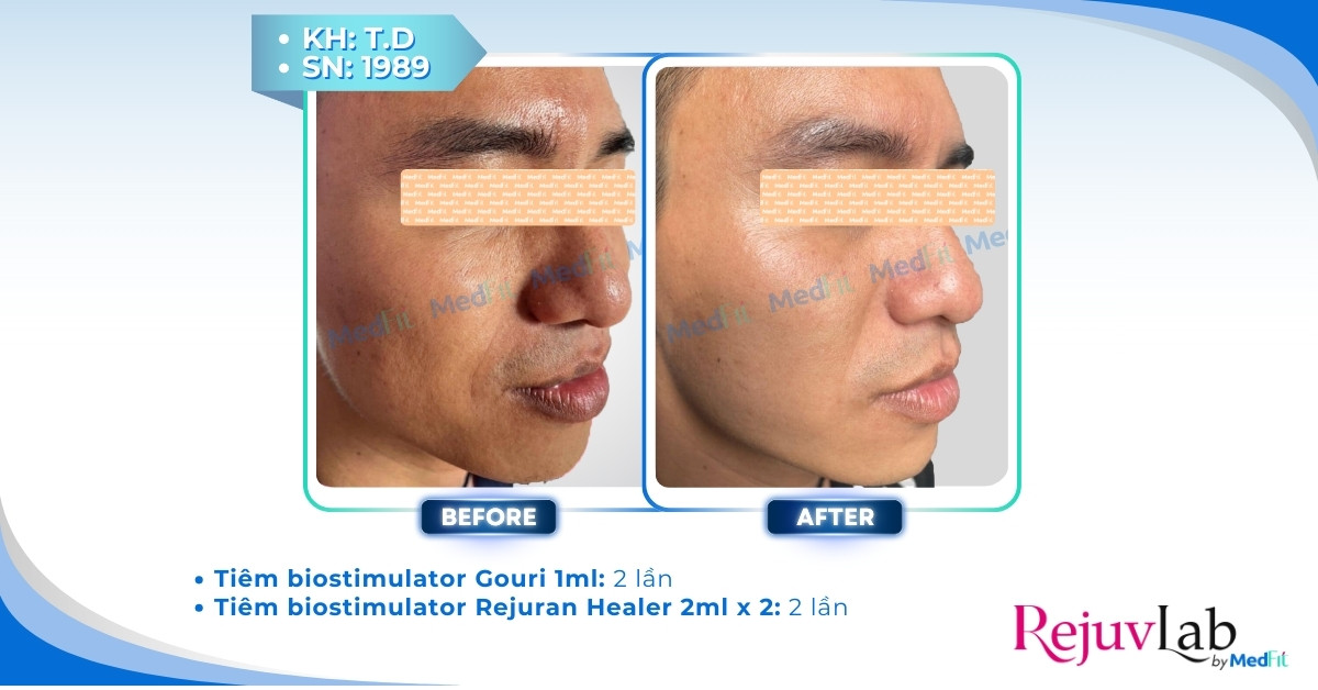 Tổng quan về chất kích thích sinh học PCL trong da liễu thẩm mỹ 13 cls trẻ hóa vùng mặt bằng gouri
