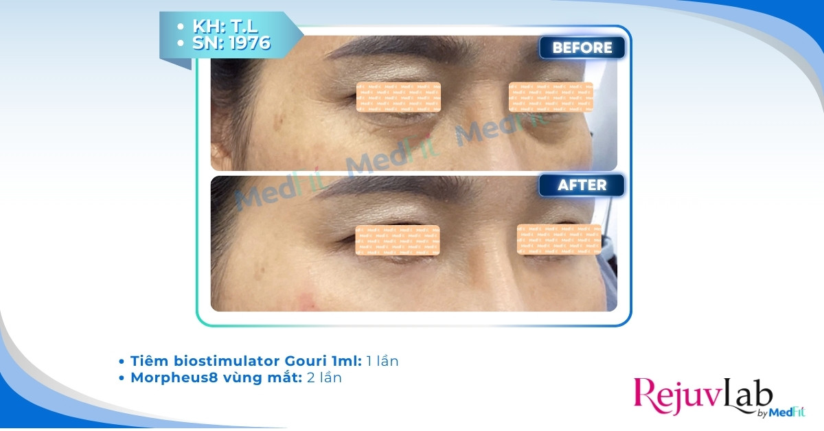 Gouri: Chất kích thích sinh học PCL thế hệ mới 4 cls trẻ hóa vùng mắt bằng gouri