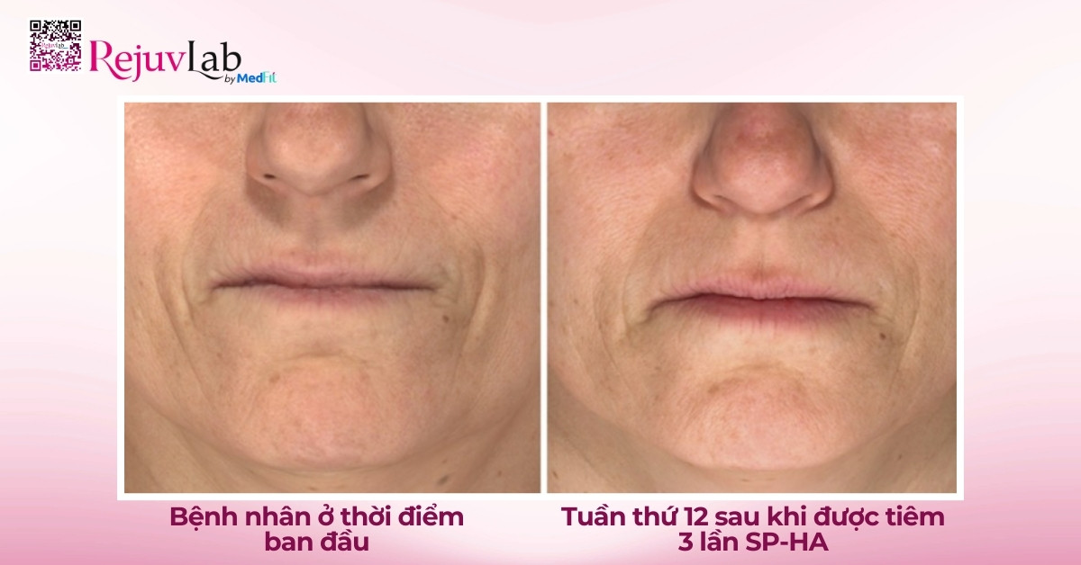 Restylane Vital và Restylane Vital Light: Restylane Skinboosters giúp khôi phục nền da khỏe mạnh từ sâu bên trong 4 hình ảnh nghiên cứu hiệu quả của restylane vital và restylane vital light