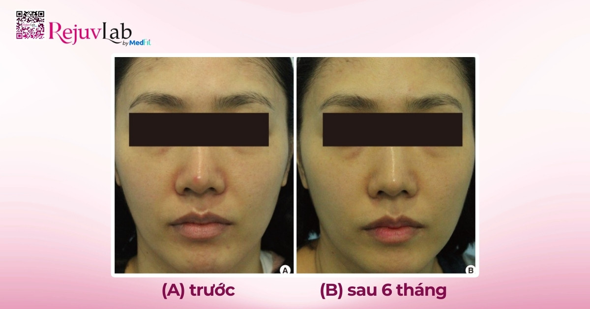 Restylane Vital và Restylane Vital Light: Restylane Skinboosters giúp khôi phục nền da khỏe mạnh từ sâu bên trong 3 hình ảnh nghiên cứu hiệu quả của restylane vital