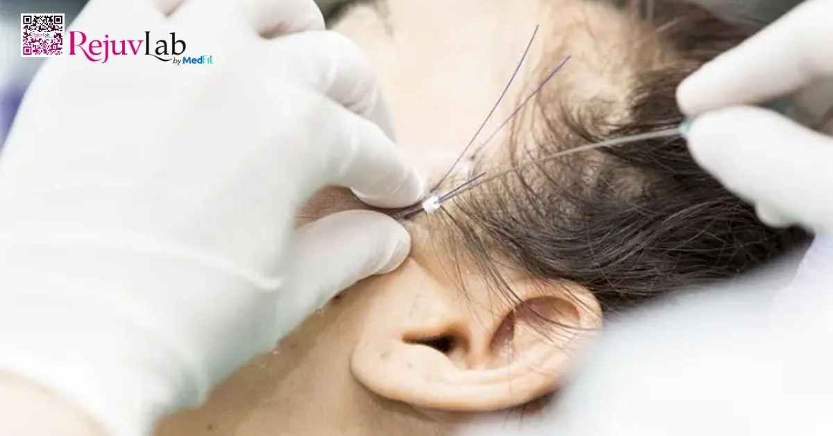 Tổng quan về chất kích thích sinh học PCL trong da liễu thẩm mỹ 7 hình minh họa cấy chỉ collagen làm đầy má hóp