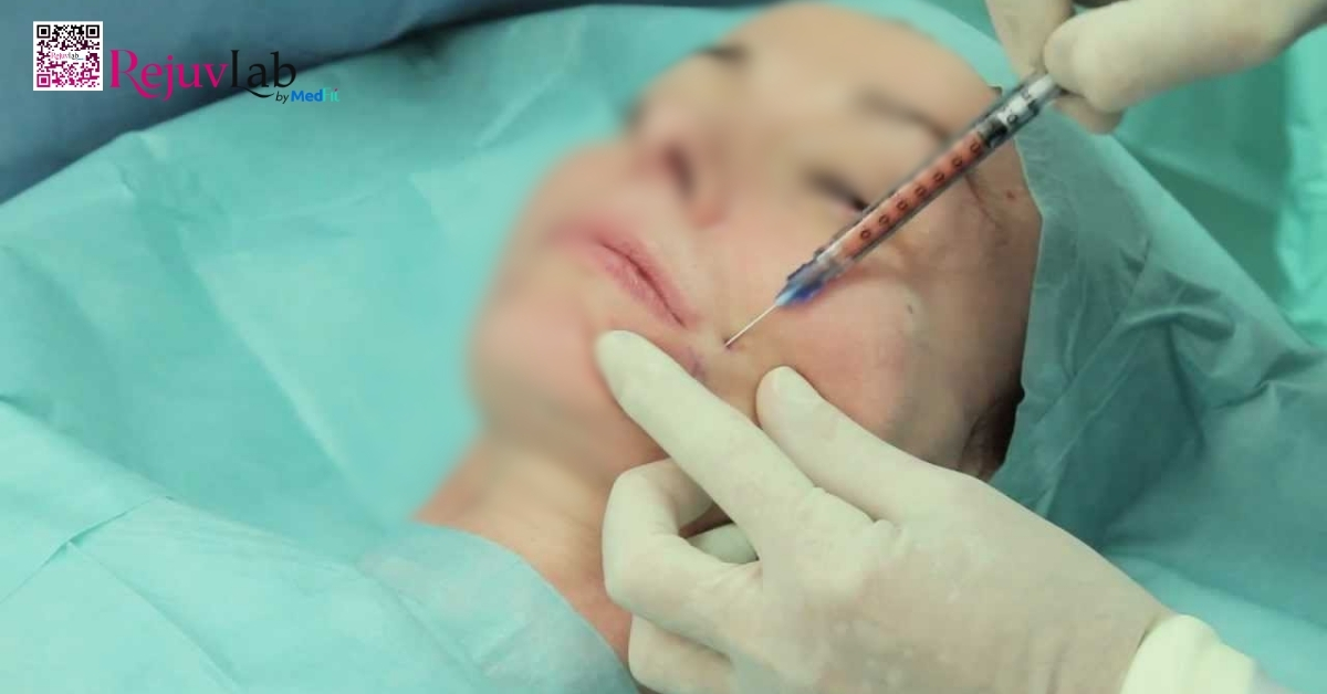 hình minh họa cấy mỡ tự thân lên mặt