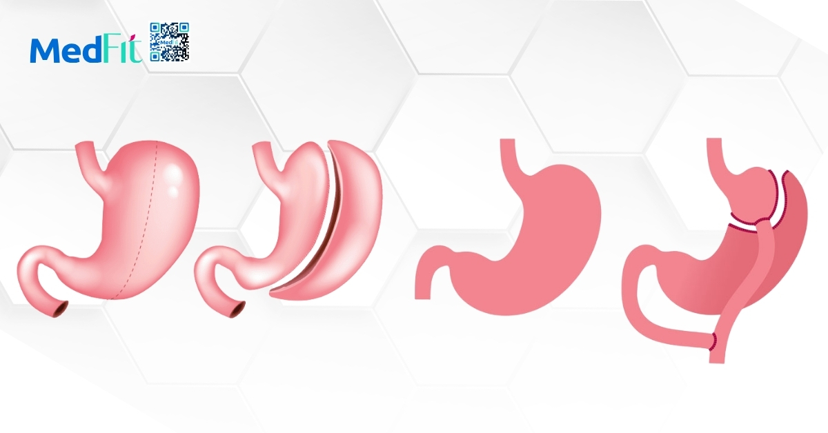 hình minh họa hai phẫu thuật chuyển hóa phổ biến tại mỹ