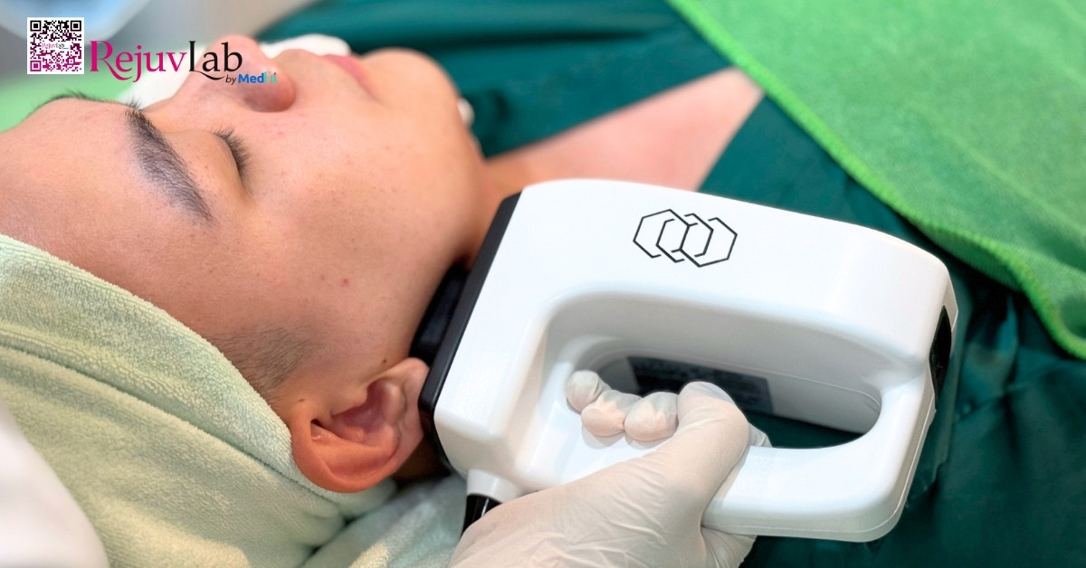 hình minh họa inmode lift mặt