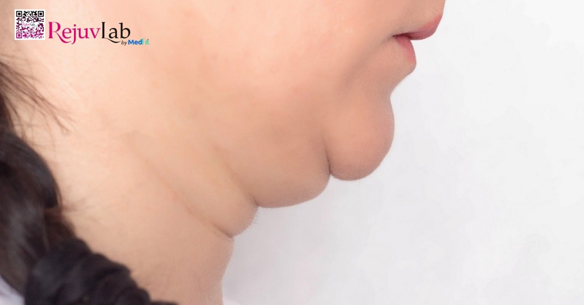 Giảm cân có giúp mặt thon gọn hơn không? 1 hình minh họa mỡ cằm tích tụ