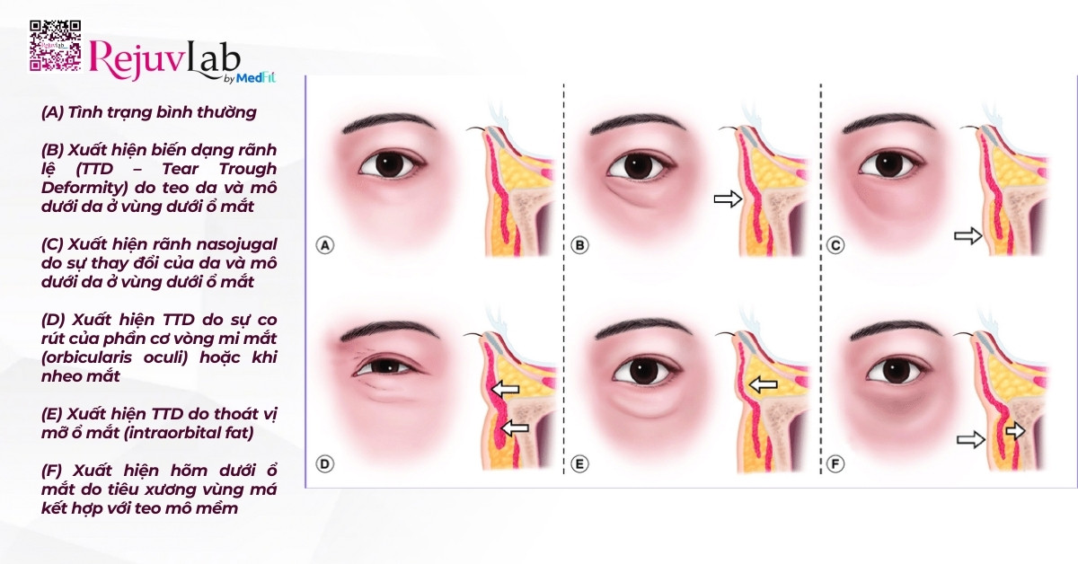 hình minh họa tear trough deformity