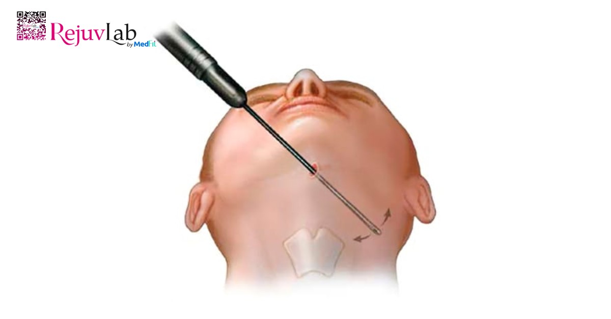 hút mỡ mặt truyền thống