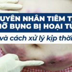 Nguyên nhân tiêm tan mỡ bụng bị hoại tử và cách xử lý kịp thời