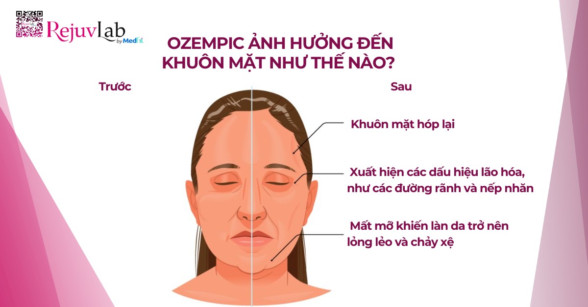 ozempic face là gì